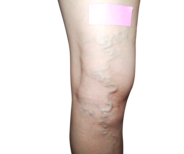 下肢静脈瘤の種類 下肢静脈瘤の専門クリニック 秋田 和歌山で日帰り手術